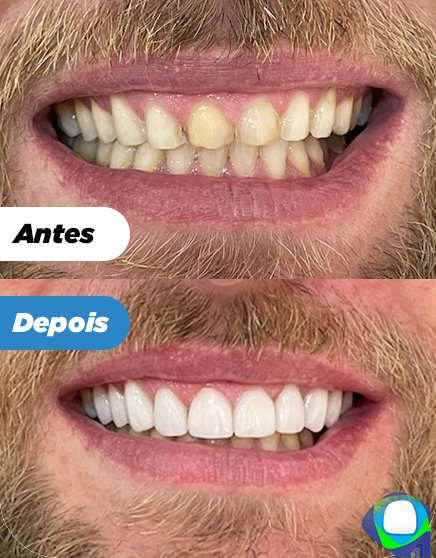 Antes e depois: Lentes de contato dental