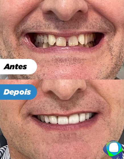 Antes e depois: Lentes de contato dental