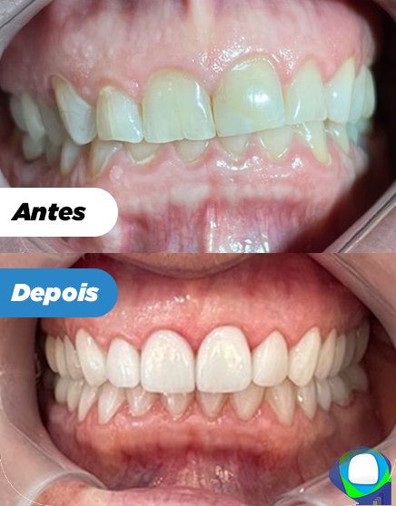 Antes e depois: Lentes de contato dental