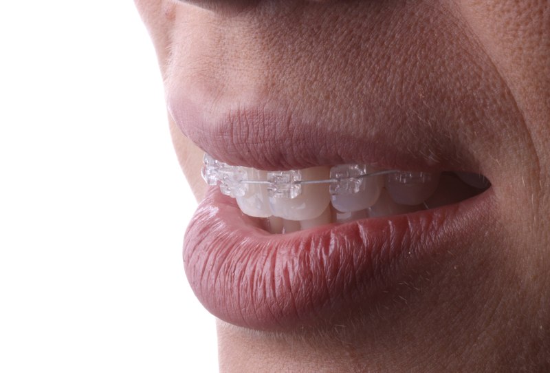 Bráquetes autoligáveis estéticos New Evolution instalados nos dentes