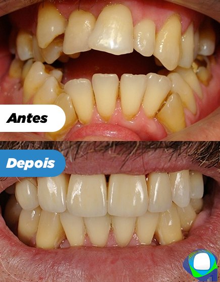 Antes e depois de paciente da Ortoligável