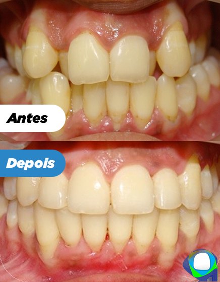 Antes e depois de paciente da Ortoligável