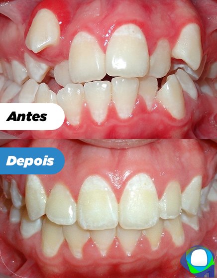 Antes e depois de paciente da Ortoligável