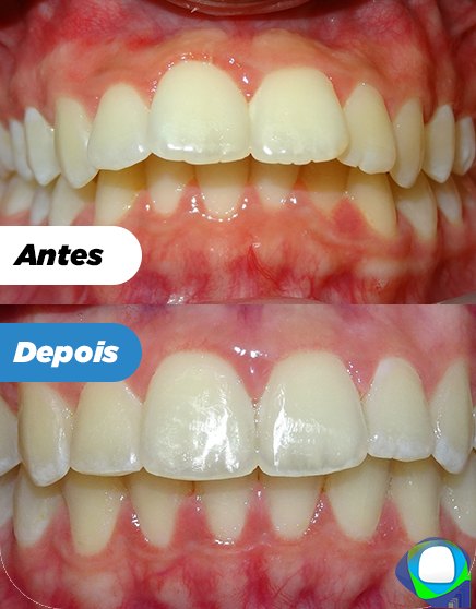 Antes e depois de paciente da Ortoligável
