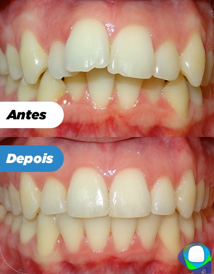 Antes e depois de paciente da Ortoligável