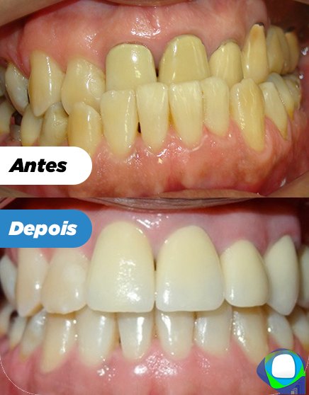 Antes e depois de paciente da Ortoligável