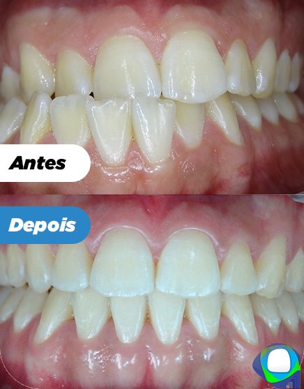 Antes e depois de paciente da Ortoligável