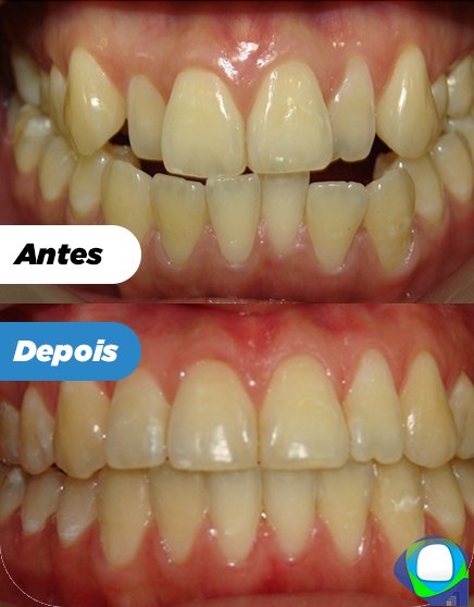 Antes e depois de paciente da Ortoligável