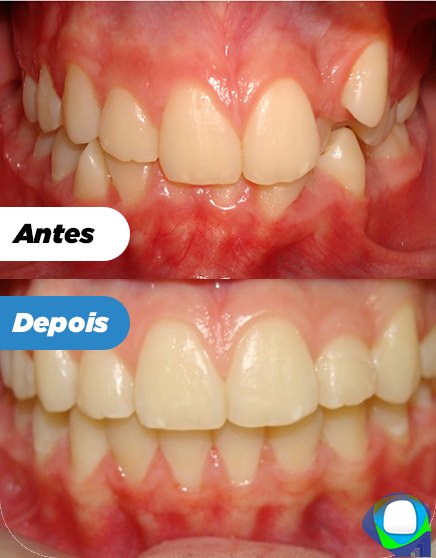 Antes e depois de paciente da Ortoligável