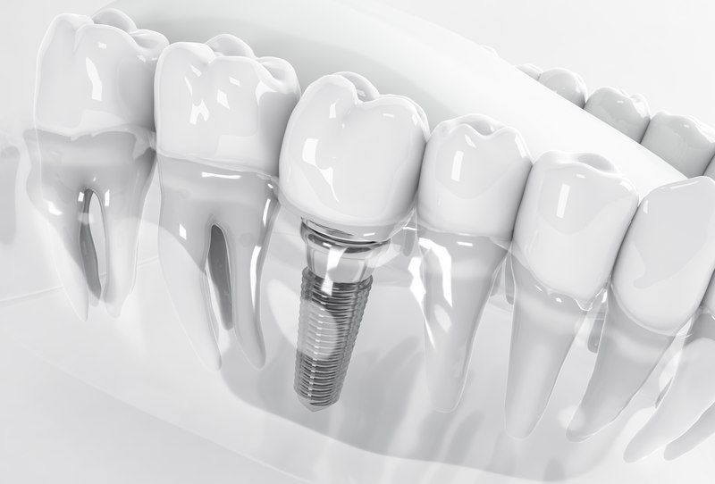 Implante dentário com pilar e coroa de porcelana