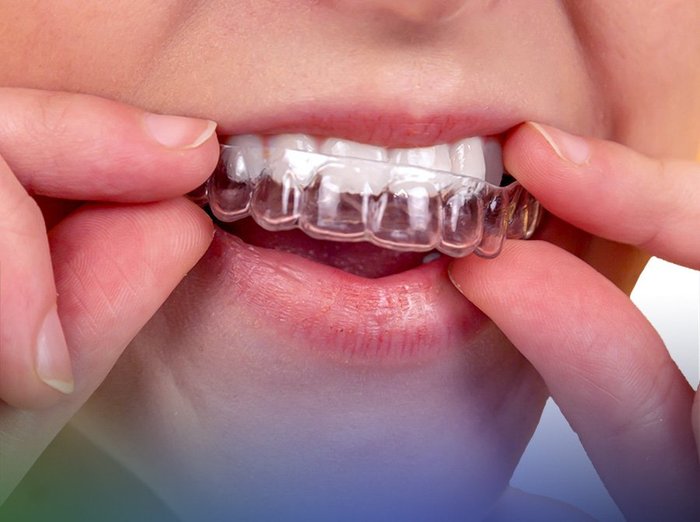 Alinhador invisível New Aligner