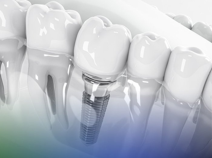 Implante dentário com pilar e coroa de porcelana